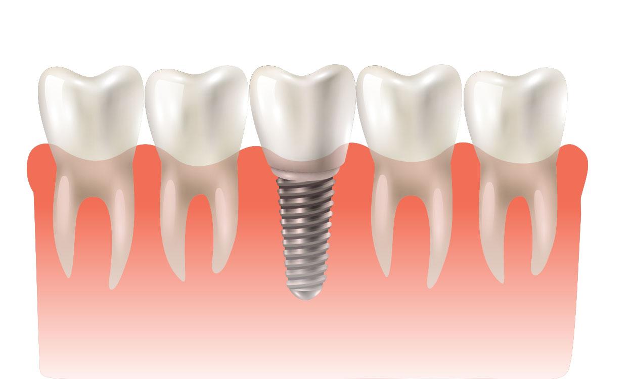 Dental Implants