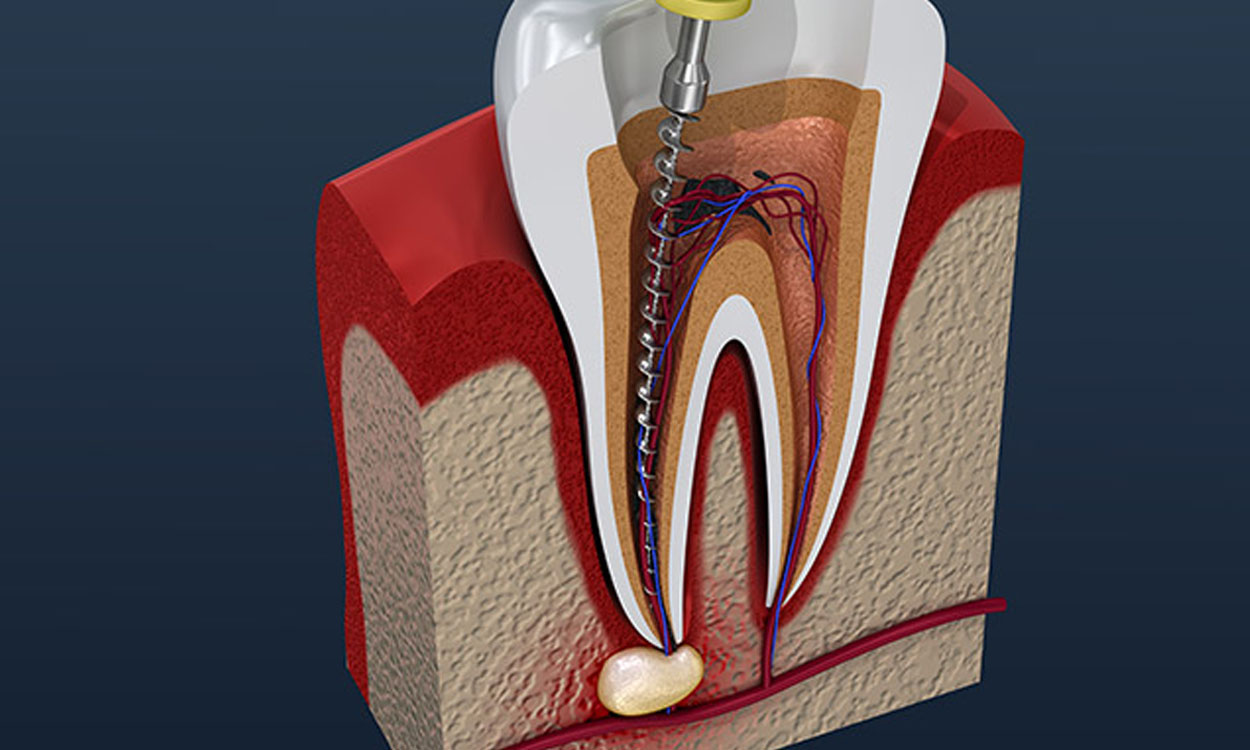 Endodontics (Root Canal Treatment)