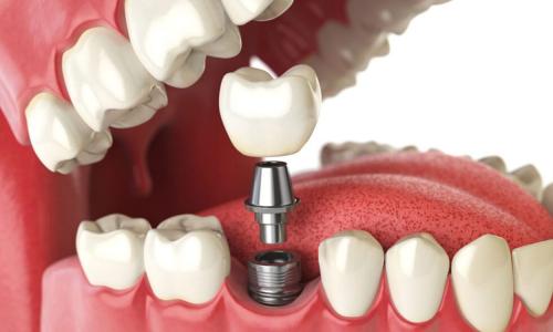 Dental Implant